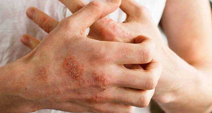 آیا اگزمای پوستی واگیر دارد؟