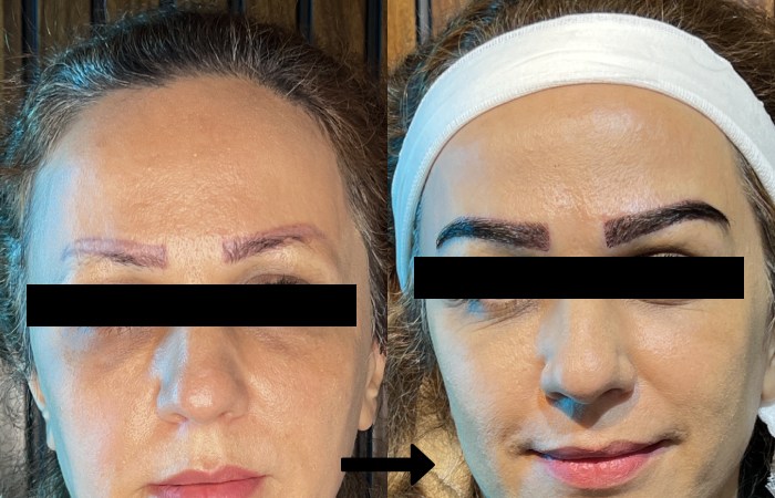 کاشت ابرو طبیعی + هزینه 1403 و معرفی بهترین کلینیک کاشت ابرو
