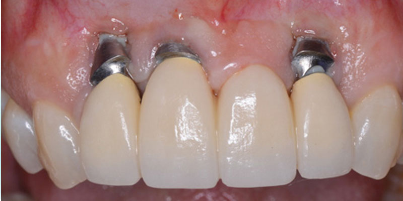 آسیب عصبی یا بافتی از عوارض کاشت ایمپلنت دندان