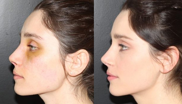 8 نکته اساسی برای کاهش ورم بینی بعد عمل جراحی + راهکار بهبودی