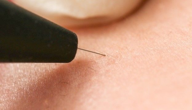 الکترولیز بهتر است یا لیزر موهای زائد: بررسی عوارض و مزایا