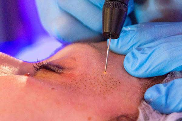 چگونه جای جوش را ازبین ببریم؟ + بررسی راهکار های درمانی