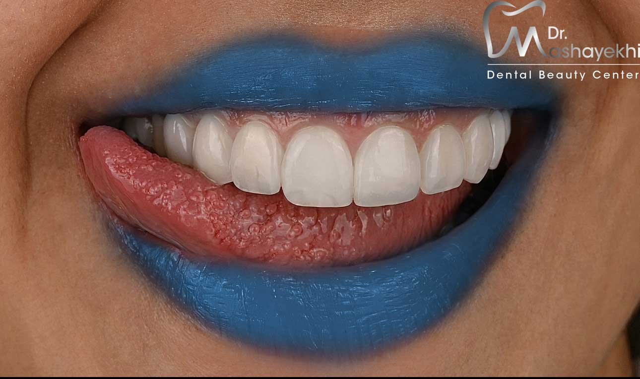 کامپوزیت ونیر دندان را در اصفهان کجا انجام دهیم؟