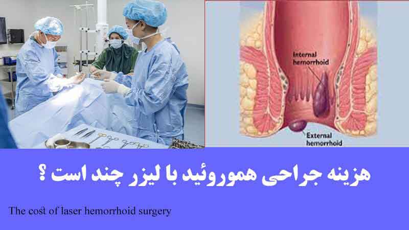 هزینه جراعی عمل بواسیر با لیزر چند است ؟