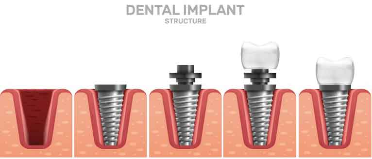 درمان های جانبی ایمپلنت دندان چیست؟