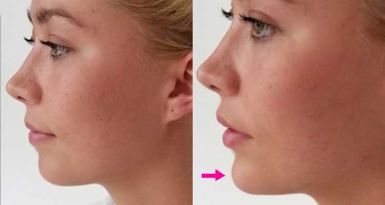 کاربرد تزریق ژل در مادلینگ و کانتورینگ صورت