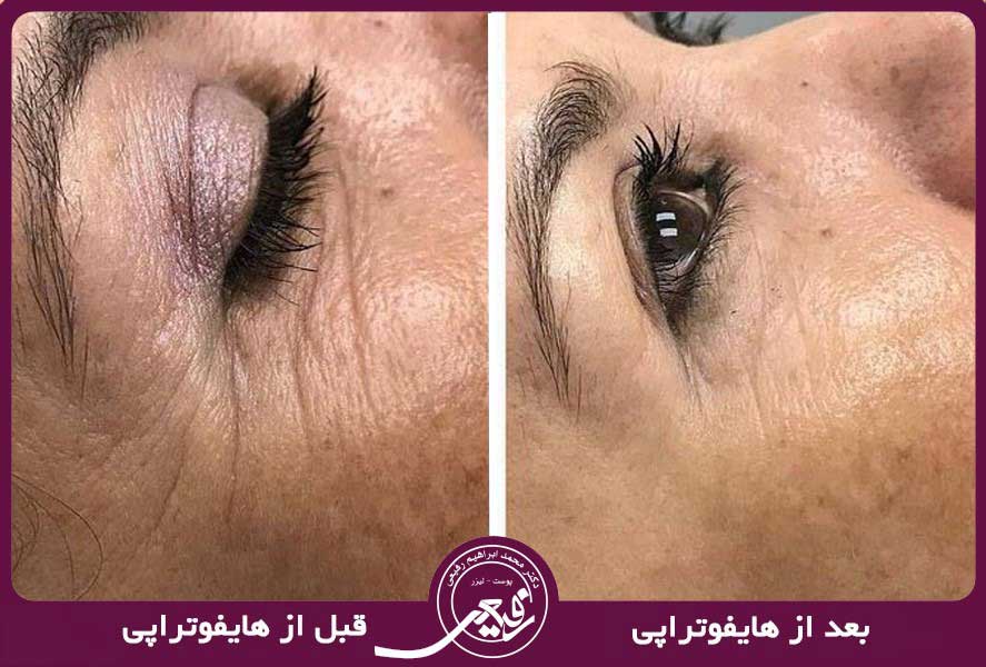 هایفوتراپی صورت موثرترین روش برای رهایی از چین و چروک