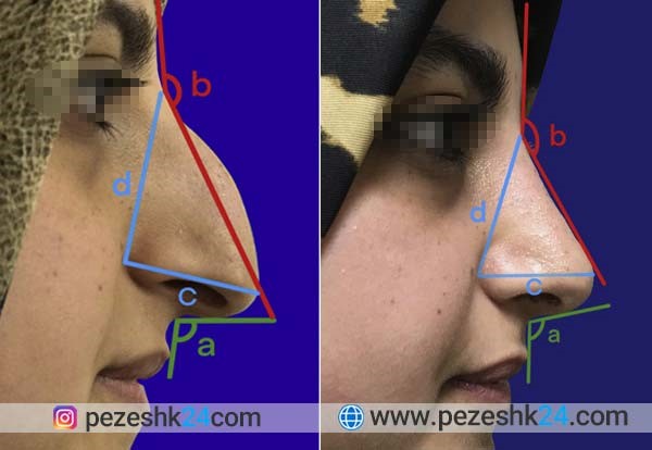 عوارض جراحی بینی بعد از چند سال؛ عوارض عمل بینی در دراز مدت