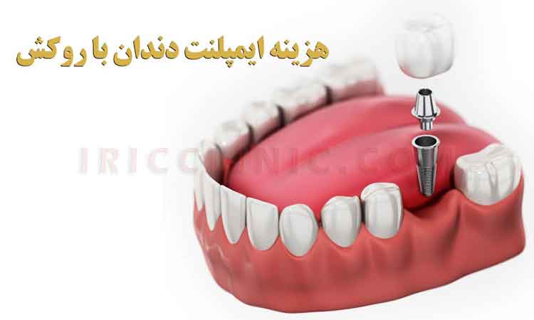 هزینه ایمپلنت دندان با روکش