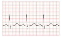 تاکی کاردی چیست ؟