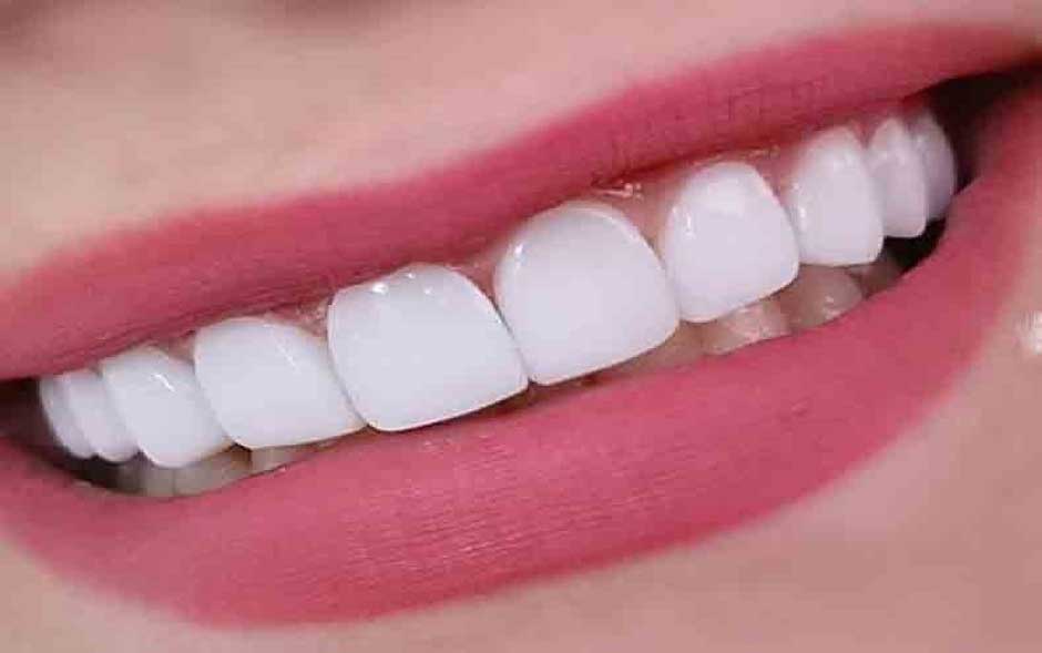 کامپوزیت دندان چیست؟