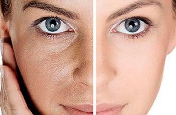 مزایای جوانسازی پوست با روش های مدرن، بدون خونریزی
