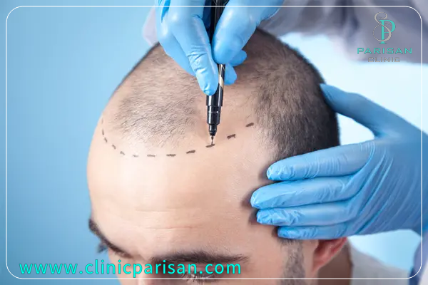 best season for hair transplant