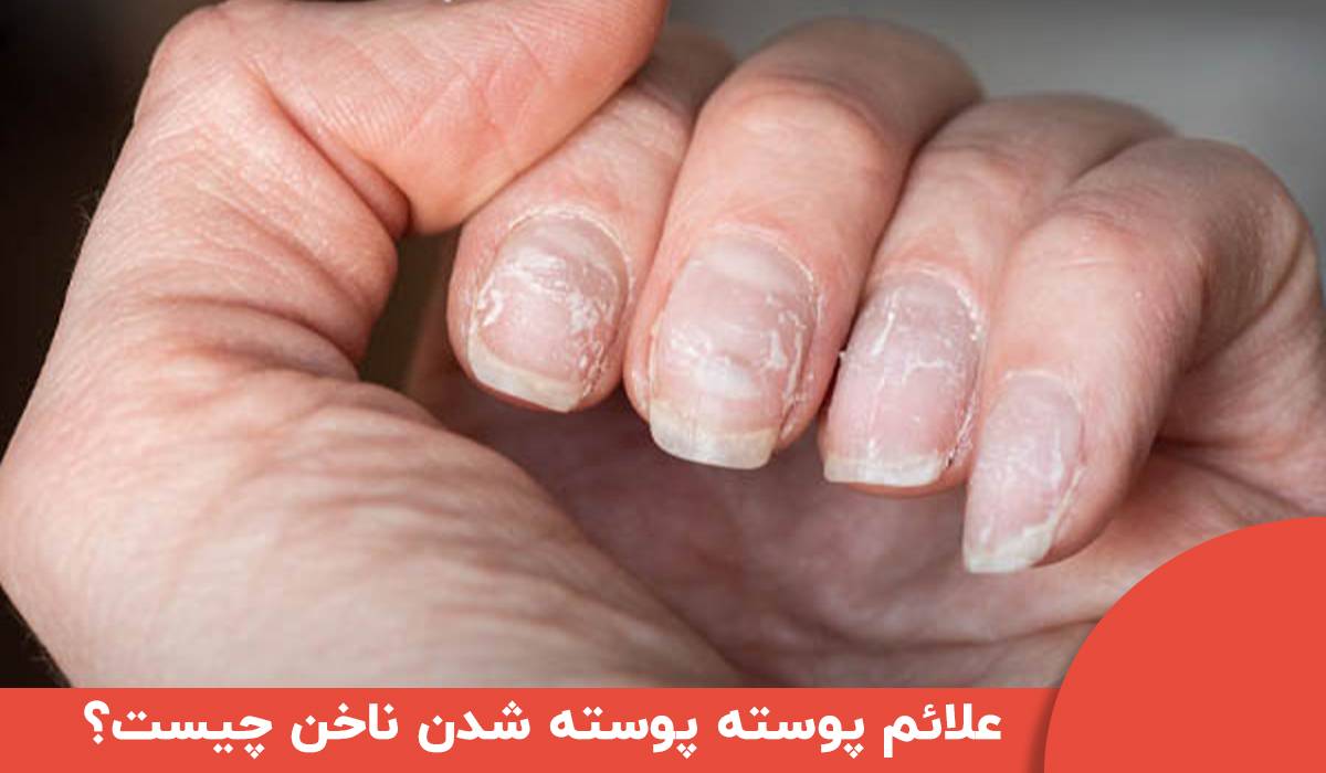 علائم پوسته پوسته شدن ناخن چیست؟