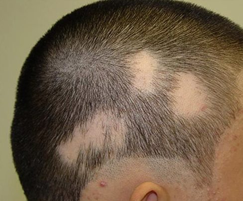 ریزش مو - دلایل و روش های درمان دارویی طاسی و کچلی