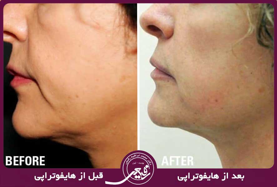 تاثیر هایفوتراپی صورت