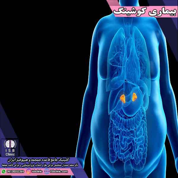 علائم بیماری کوشینگ و روش های درمان آن