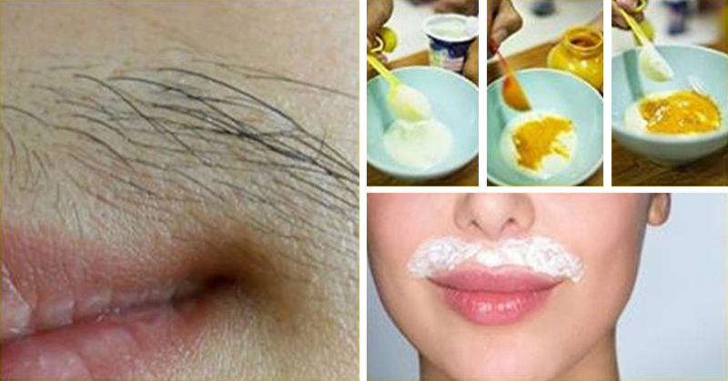 از بین بردن موی پشت لب در دخترها با روش های خانگی موثر