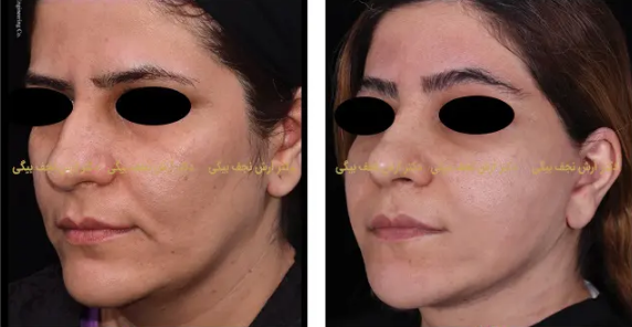 جوانسازی پوست صورت با لیفتینگ - روش‌های رایج برای جوانسازی صورت