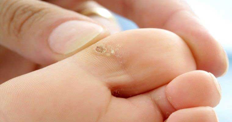 میخچه چیست و برای برداشتن آن باید به چه دکتری مراجعه کنیم؟