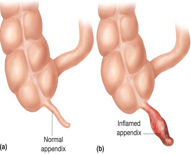 نحوه درمان آپاندیسیت 