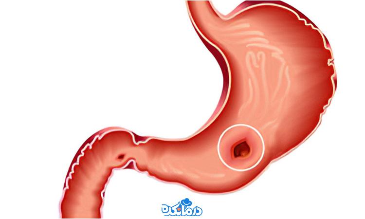 علت معده درد عصبی چیست؟