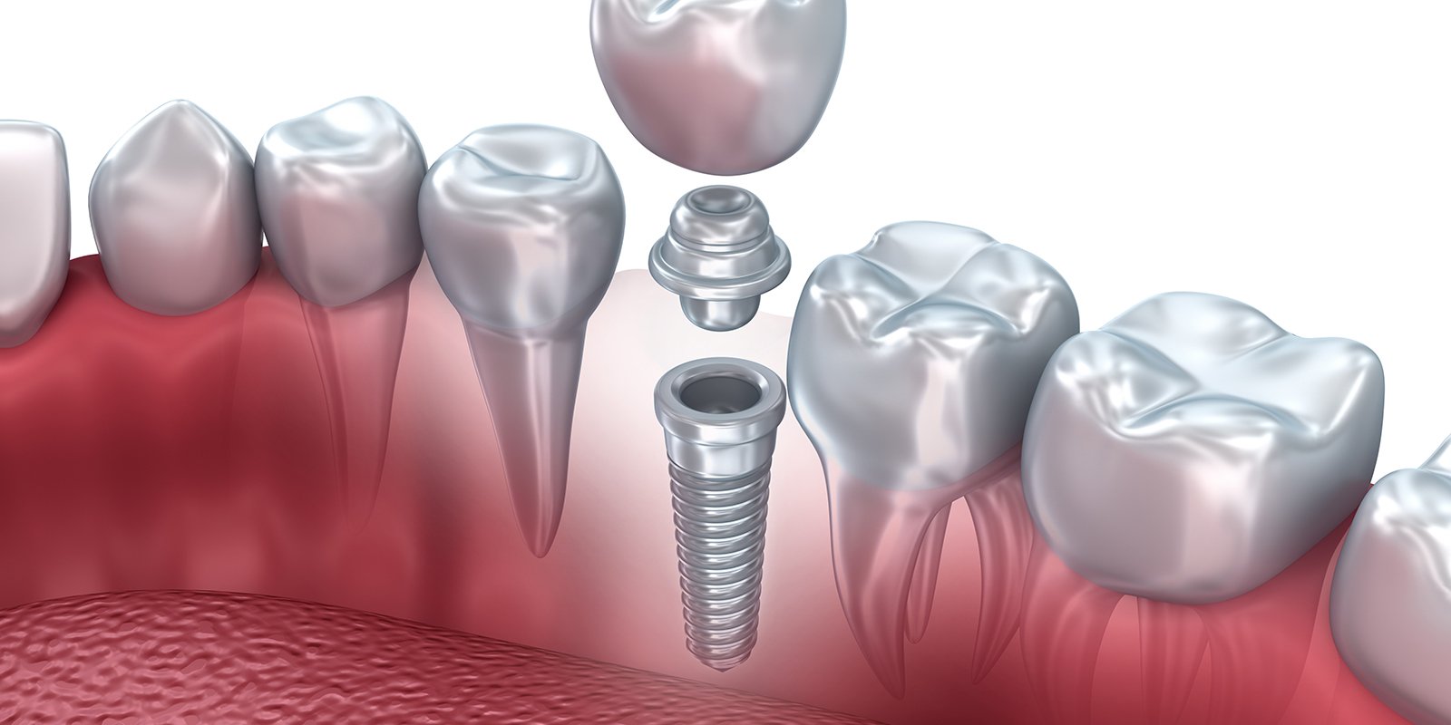 تفاوتهای ایمپلنت معمولی با ایمپلنت دیجیتال