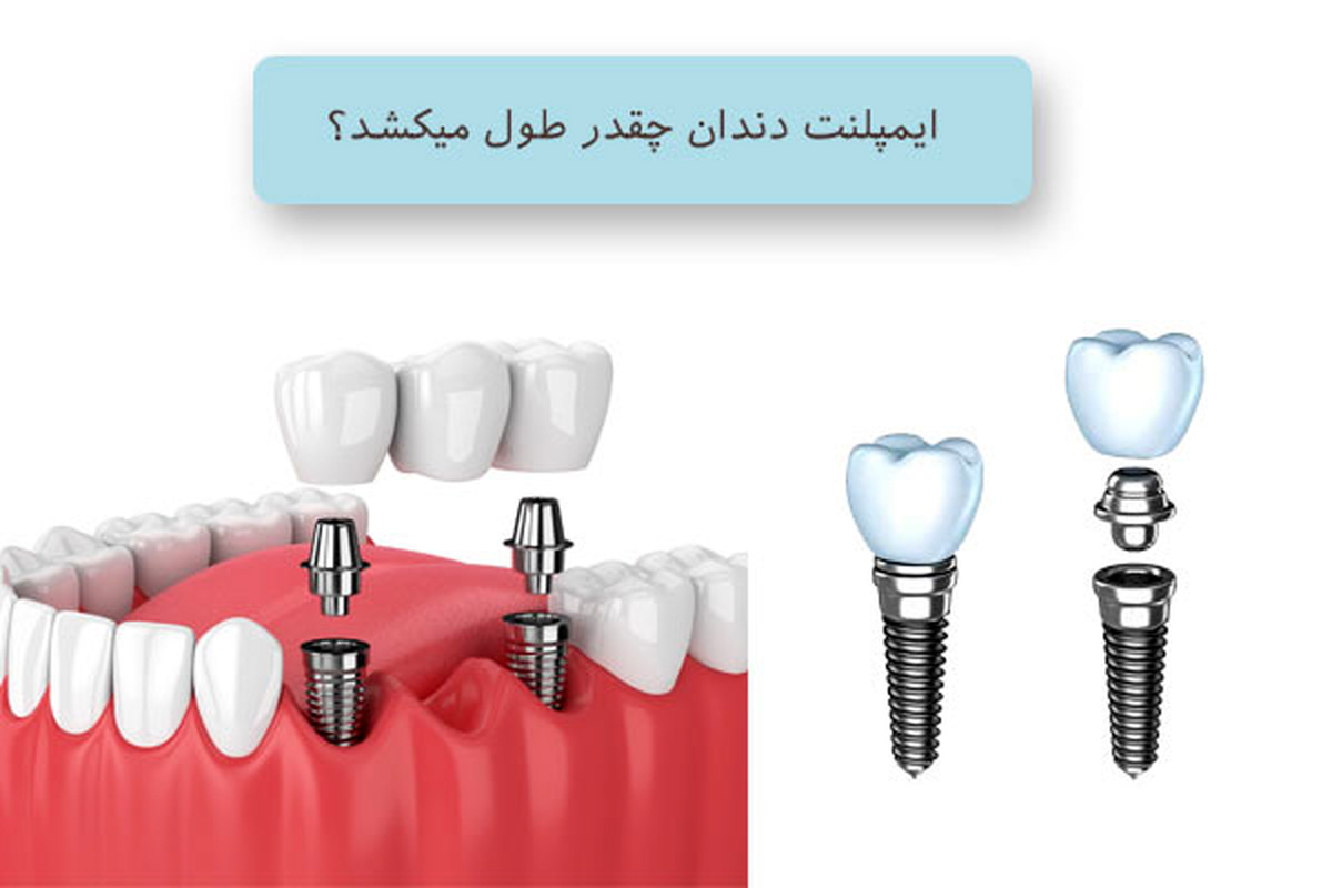 مراحل جراحی ایمپلنت