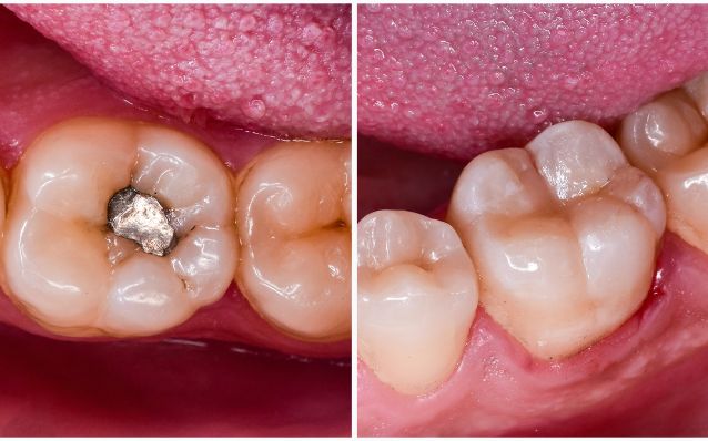 شناخت آمالگام و معرفی بهترین برند های آمالگام