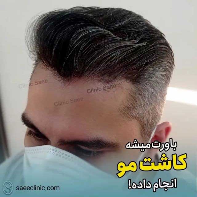هزینه‌های کاشت مو در سال 1401
