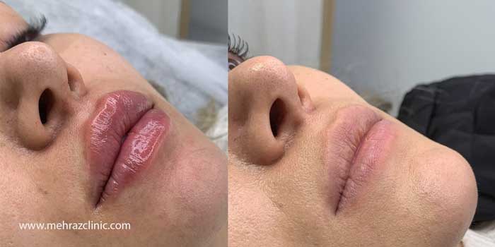 نکات مهم مارک های ژل لب