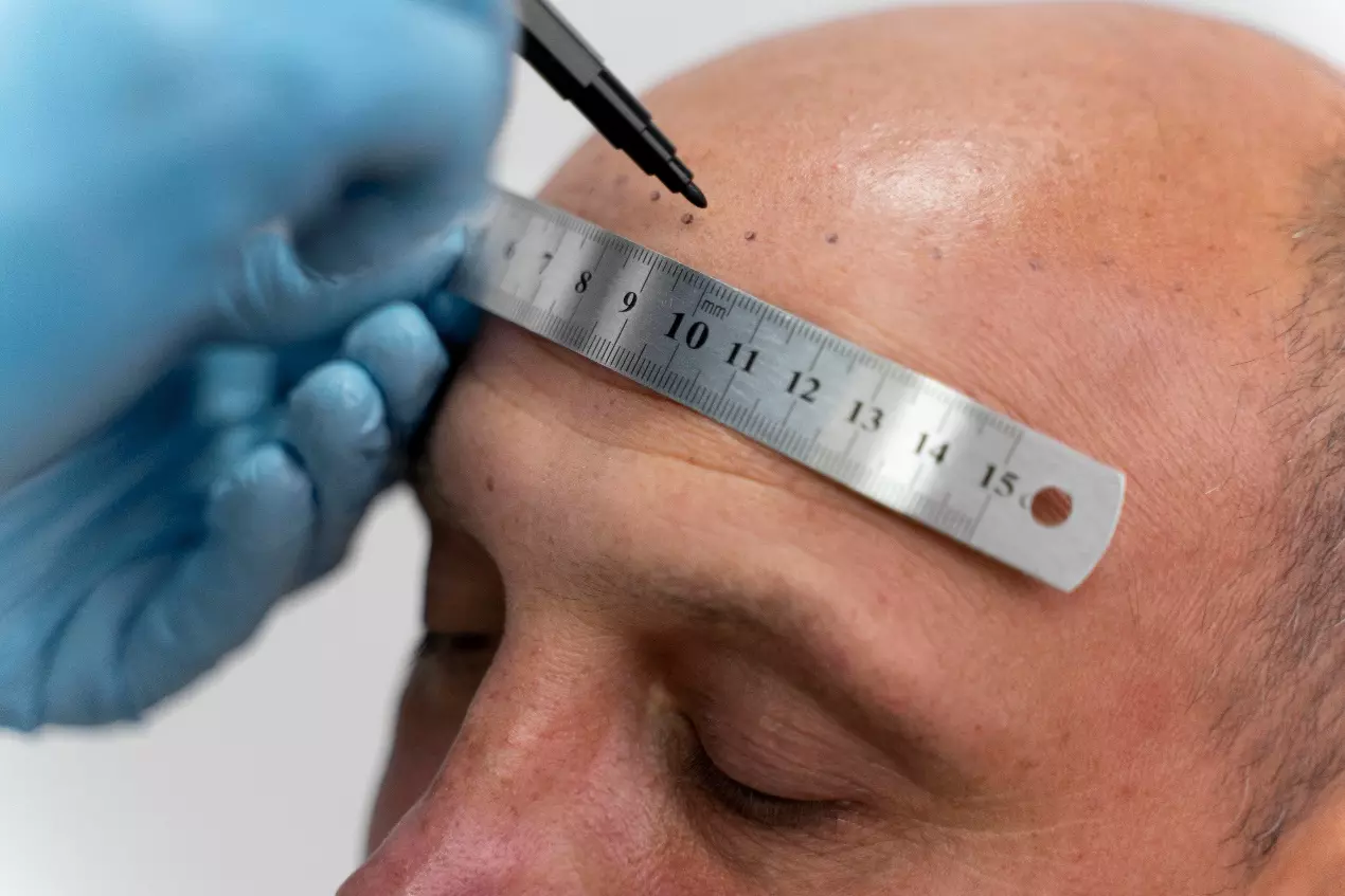 تاثیر بوتاکس بر سردردهای میگرنی