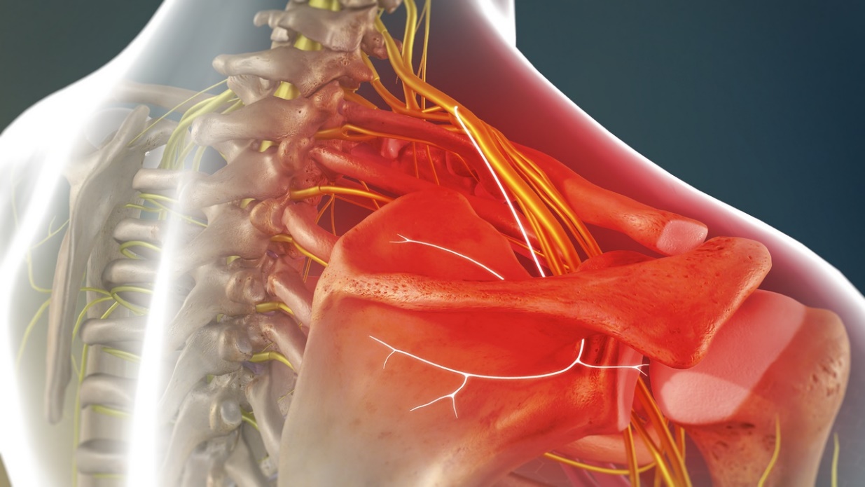 درد عصبی شانه از تشخیص تا درمان