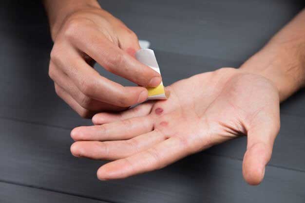 میخچهها امکان شکلگیری روی دستها را هم دارند