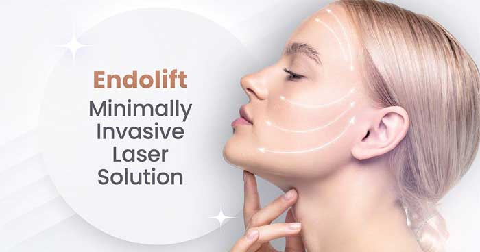 The Endolift Non-Surgical Face Lift: Your Complete Guide | by My Nuceria |  Sep, 2023 | Medium
