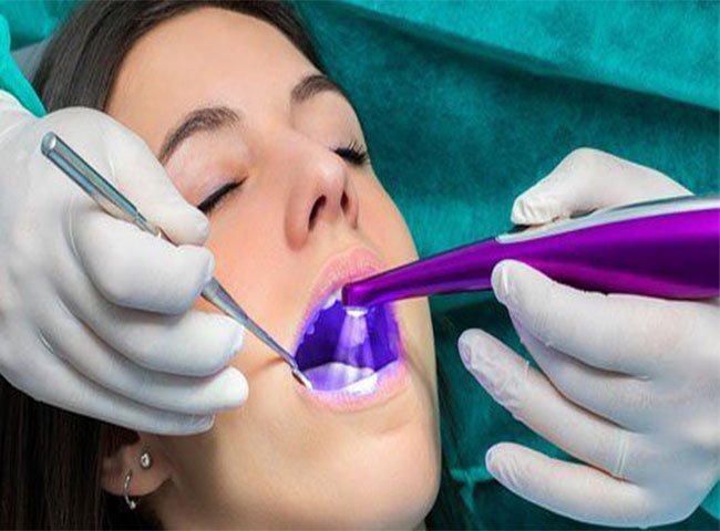 بهترین زمان انجام فیشور سیلانت دندان