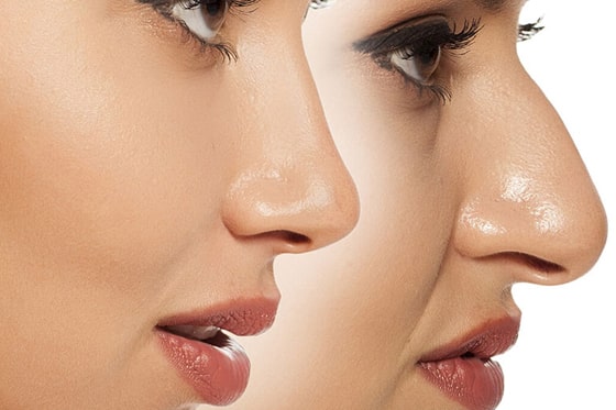 آیا تیپ پلاستی دائمی است