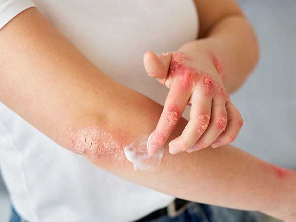 آیا اگزمای پوستی واگیر دارد؟