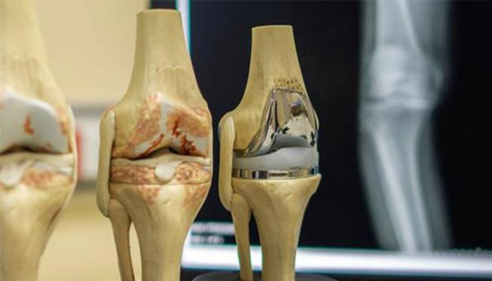 جراحی تعویض مفصل زانو