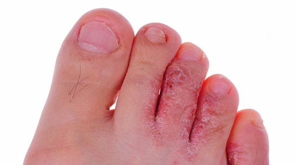 درمان های گیاهی پای ورزشکار