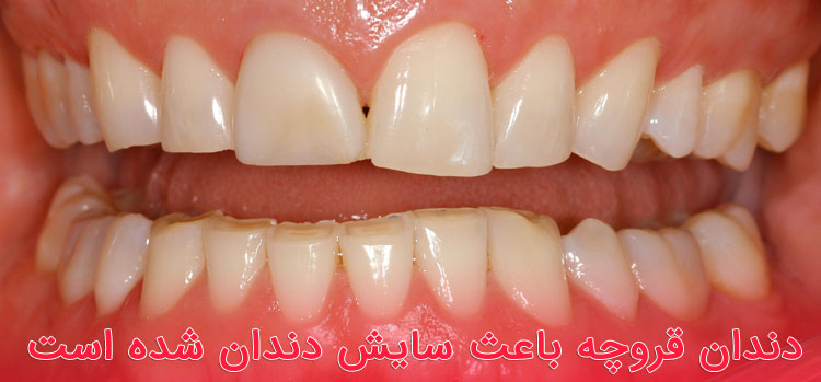 دندان قروچه باعث سایش دندان می شود
