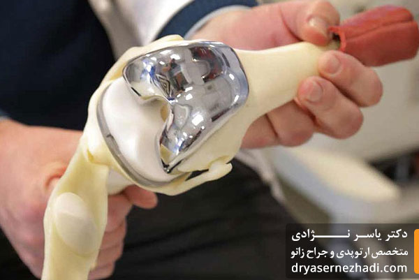 پاسخ به رایج ترین سوالات در مورد تعویض مفصل زانو