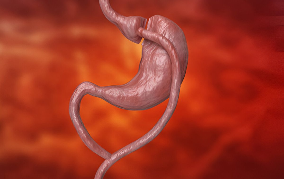 عمل بای پس معده چیست؟