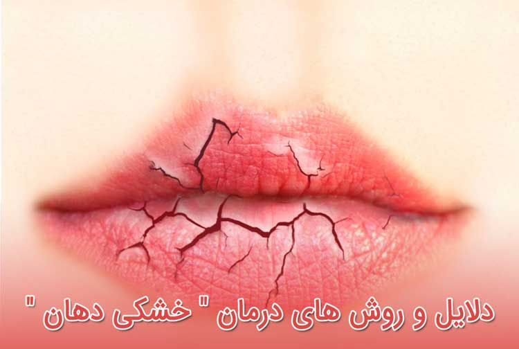 خشک شدن دهان - دلایل و روش های درمان " خشکی دهان "