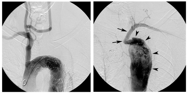 دست های همیشه سرد به دلیل بیماری برگر یا&nbsp;ترومبوآنژئیت انسدادی