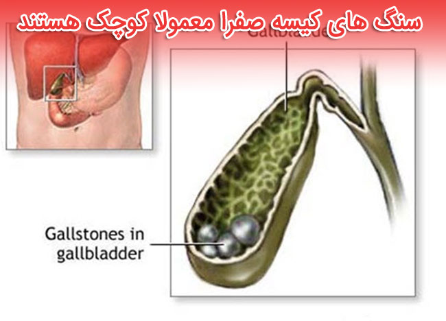 سنگ کیسه صفرا - علائم - دلایل و راههای درمان سنگ کیسه صفرا