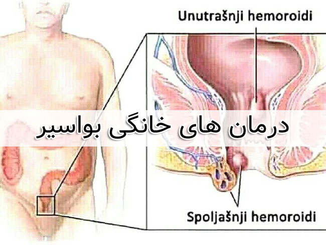 درمان هموروئید و بواسیر با روش های گیاهی و خانگی