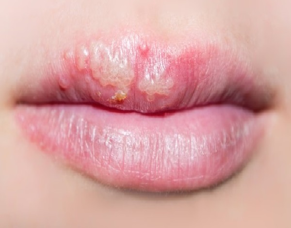 روش های درمان تبخال,پیشگیری از تب خال,علائم تبخال کودکان