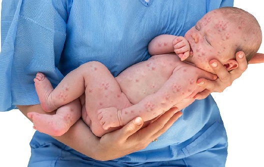 علائم و درمان تبخال کودکان + پیشگیری و علت و داروی تب خال نوزادان