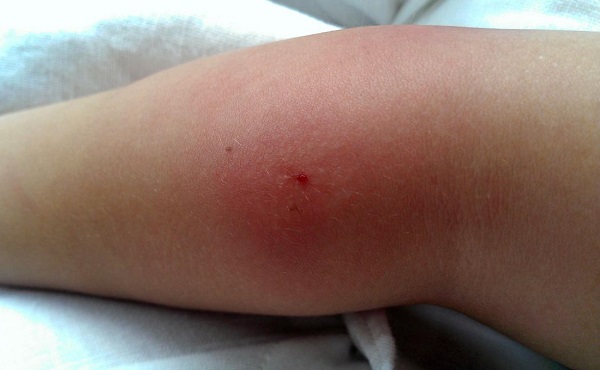 علائم عفونت مفاصل و درمان عفونت استخوان در کودکان + علت عفونت